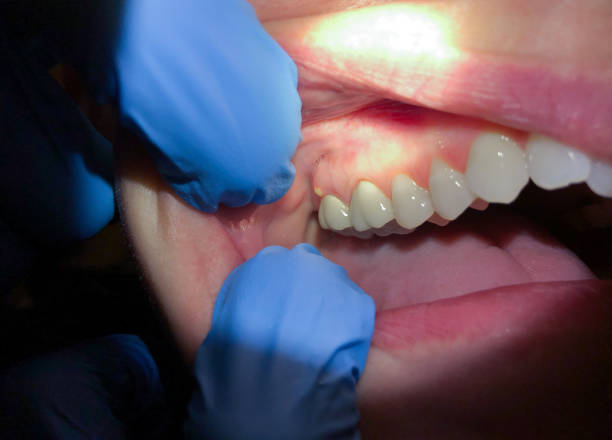 Best Emergency Dental Care for Abscessed Tooth in Prospect Park, NJ